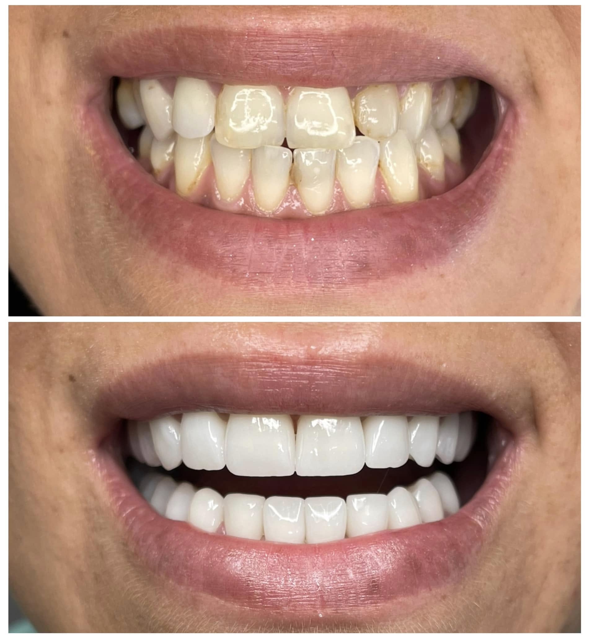 keramičke krunice – protetski rad