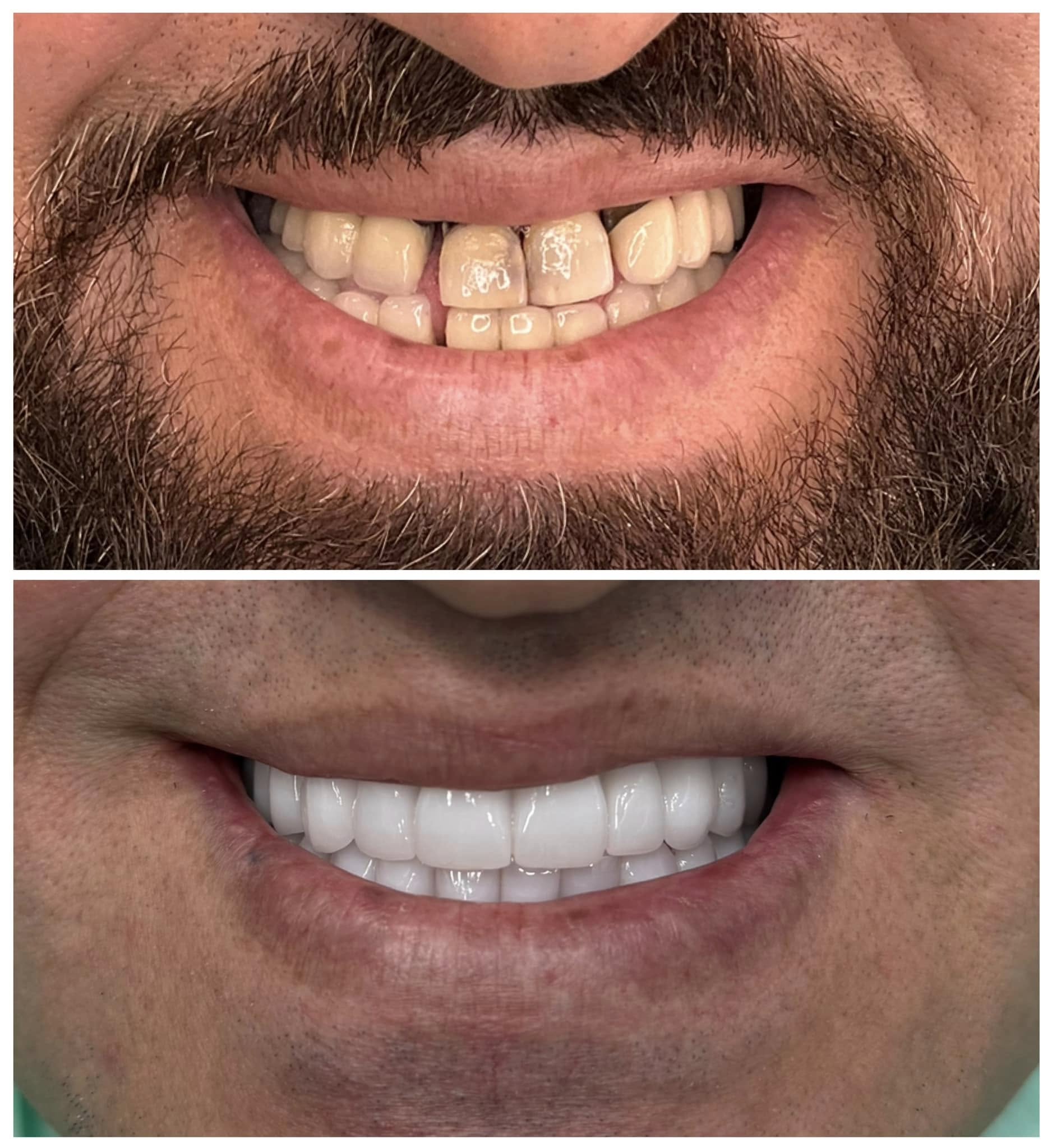 mostovi – nadoknada zuba