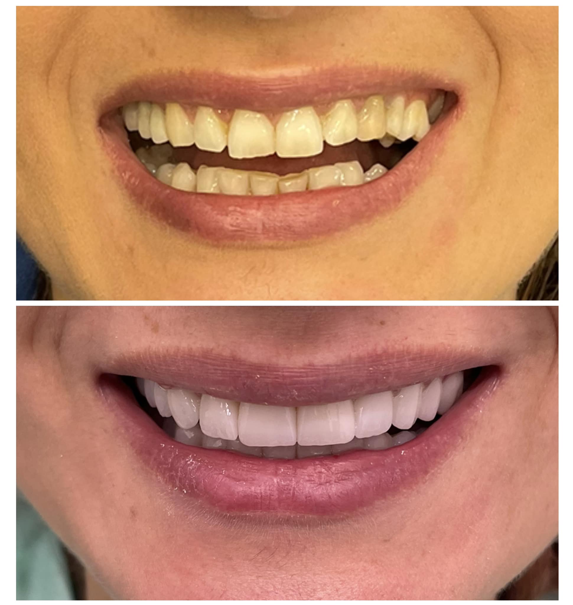 protetska rekonstrukcija – prije i poslije