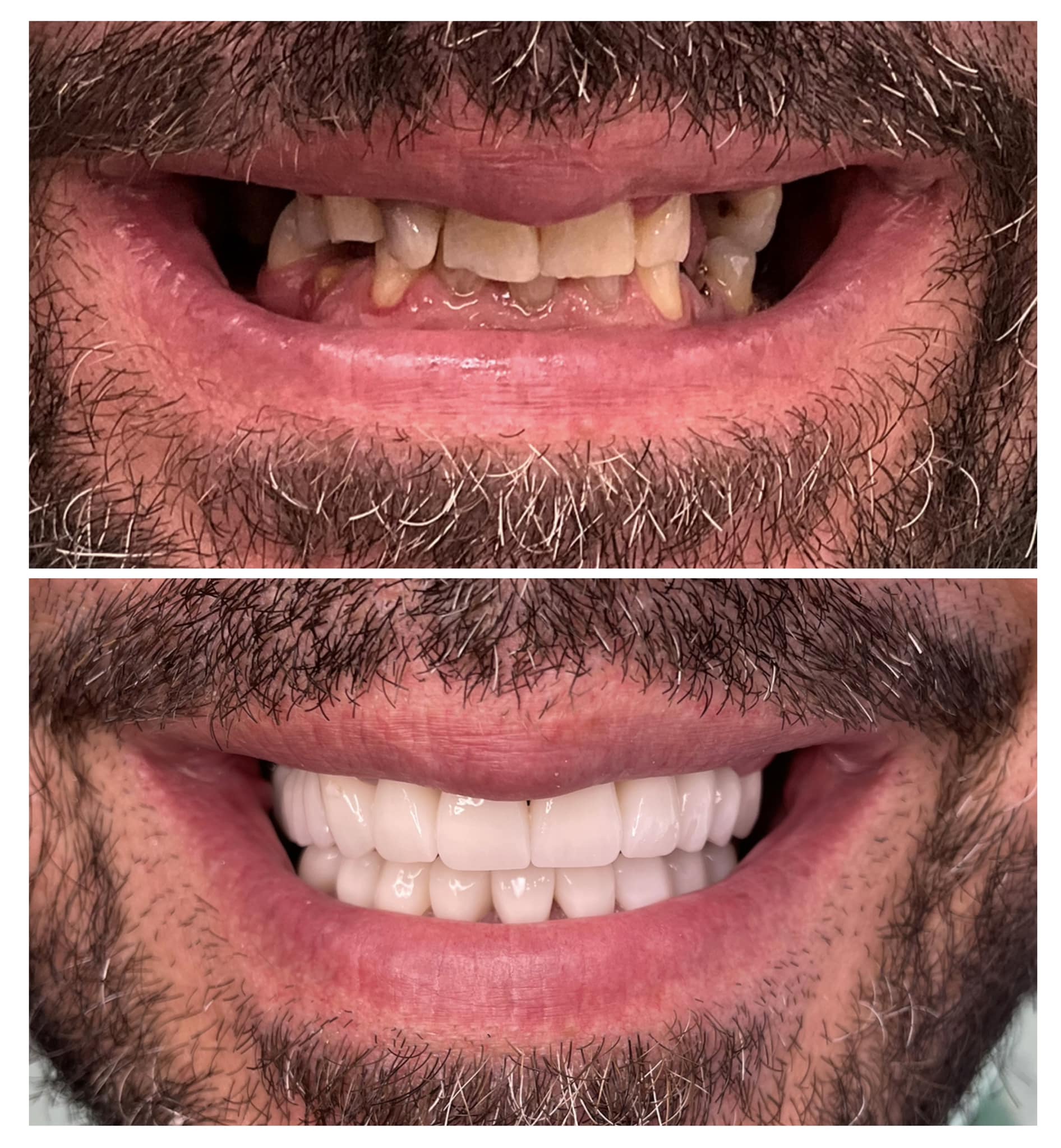 fiksna protetika – zahvat