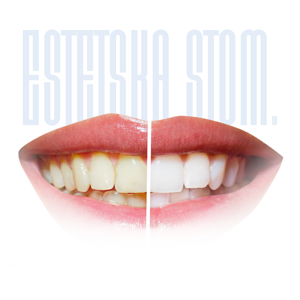 aesthetic dentistry – veneers