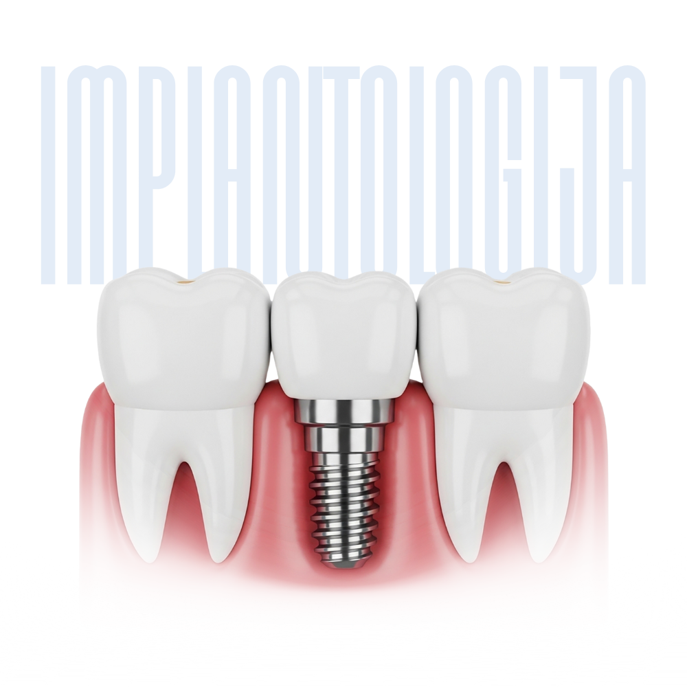 dental implants – implantology